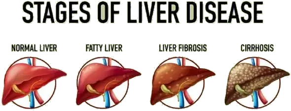 Stages of liver disease